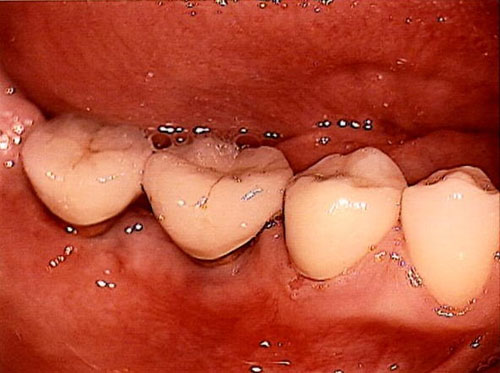 Zahnersatz Implantate mit keramisch vollverblendeten Kronen 15 Jahre nach der Versorgung