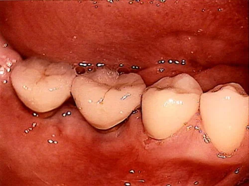 Implantate mit keramisch vollverblendeten Kronen.