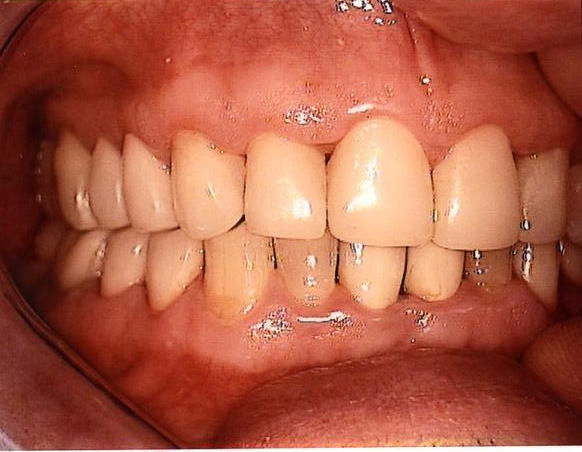 9 Jahre nach der Versorgung mit klassischen, hauchdünnen Veneers aus Keramik