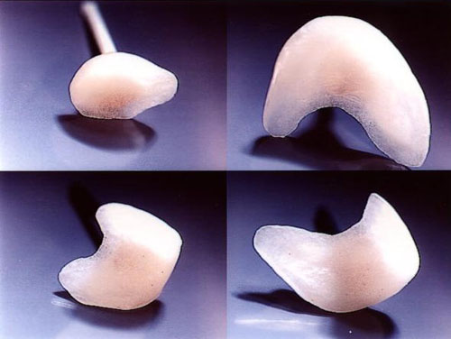 Mini-Veneers aus Vollkeramik